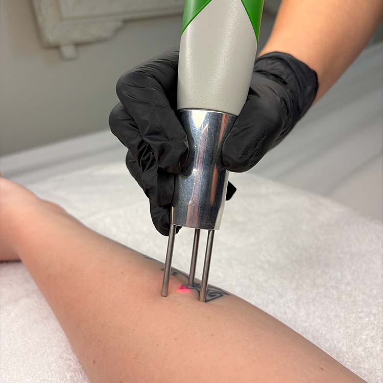 Détatouage (laser Q-Switch)